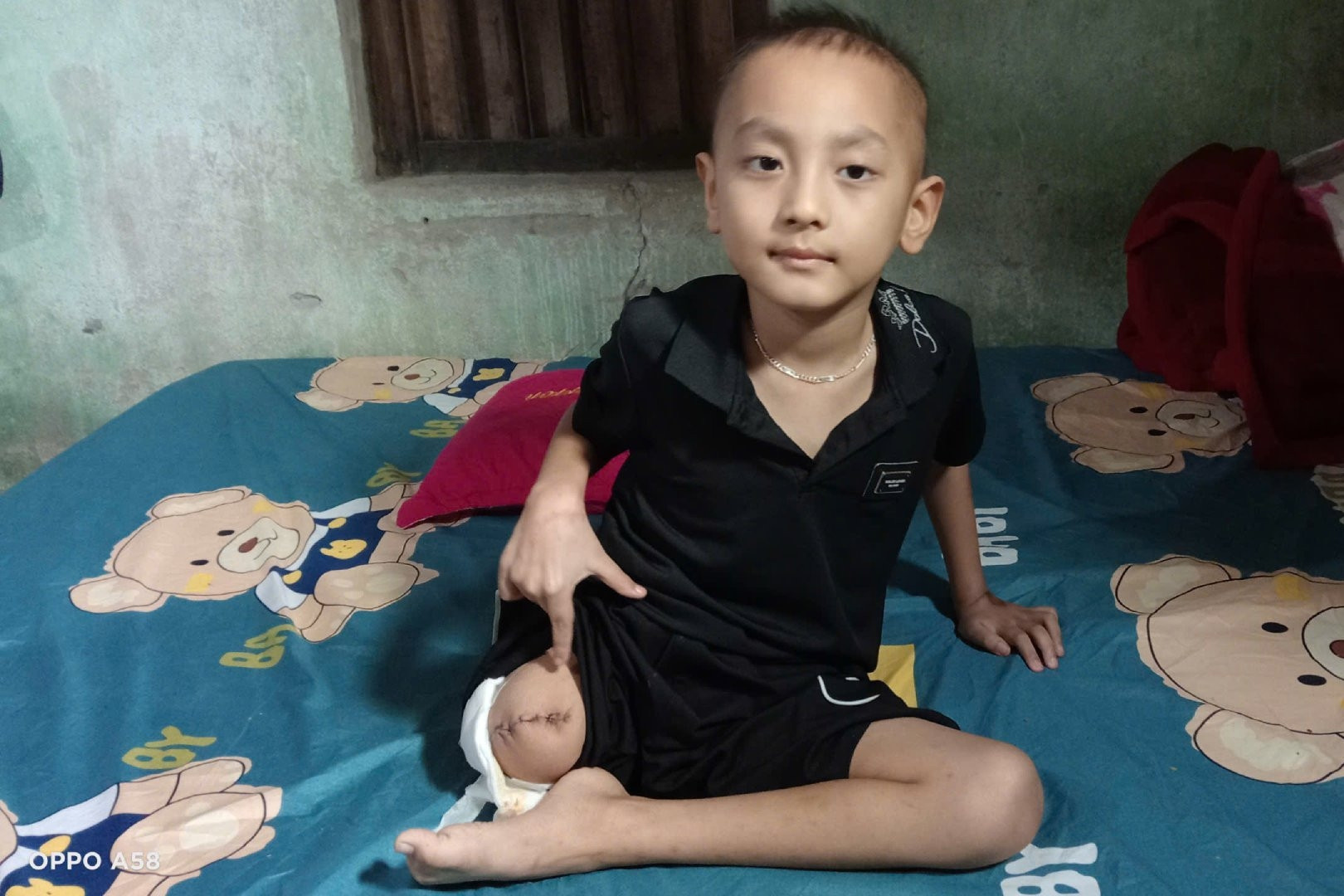 Ung thư cướp mất chân của cậu bé 6 tuổi, gia đình kiệt quệ cầu mong phép màu