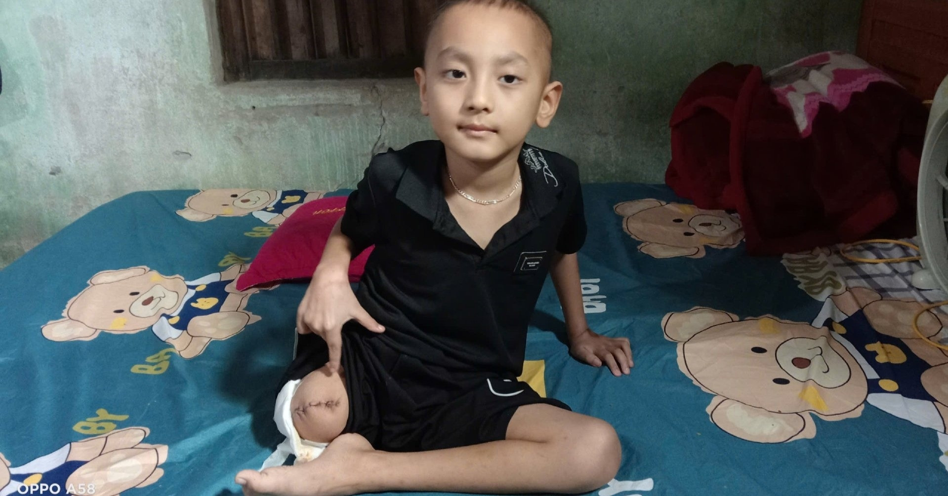 Ung thư cướp mất chân của cậu bé 6 tuổi, gia đình kiệt quệ cầu mong phép màu