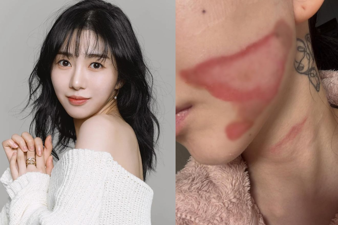 Gương mặt nữ ca sĩ 33 tuổi bị bỏng nghiêm trọng sau thẩm mỹ