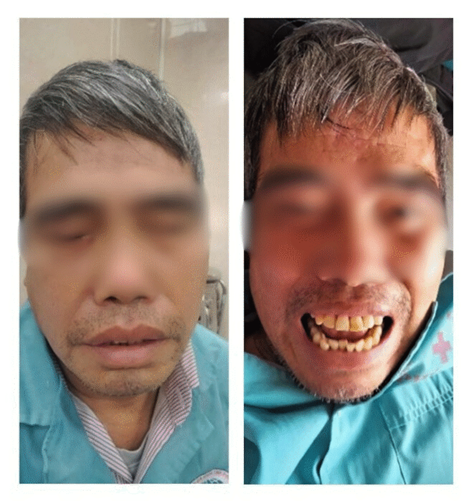 Người đàn ông 60 tuổi không thể nhắm mắt và há miệng, lộ hội chứng hiếm gặp đột quỵ .png