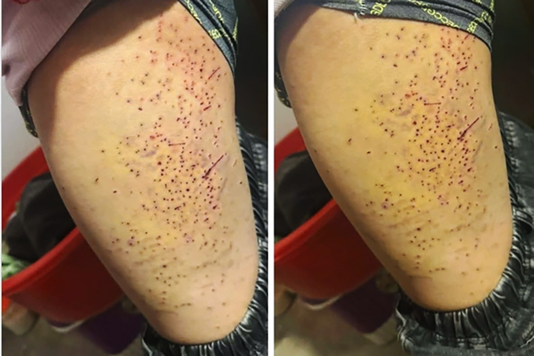 Tranh chấp chỗ ngồi, nữ sinh lớp 7 dùng bút bi đâm nhiều lần vào đùi bạn học