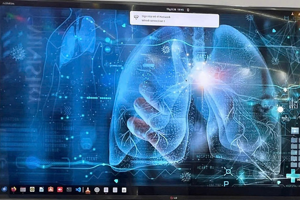 AI giúp phát hiện ung thư phổi giai đoạn rất sớm