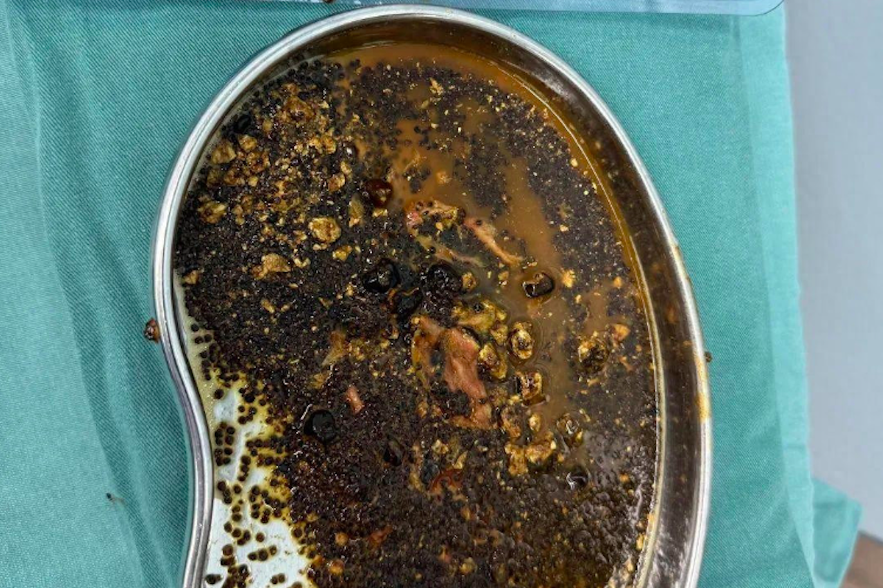 Thực hư tin đồn 'uống sữa hạt giảm cân gia tăng sỏi mật'