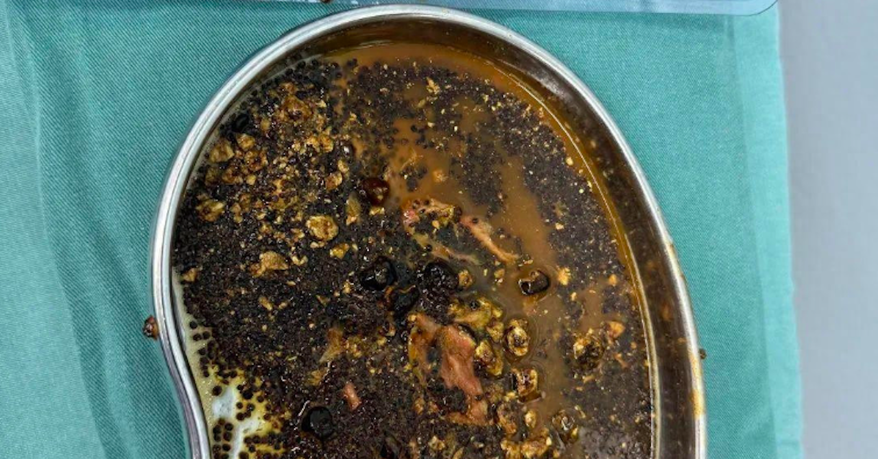 Thực hư tin đồn 'uống sữa hạt giảm cân gia tăng sỏi mật'