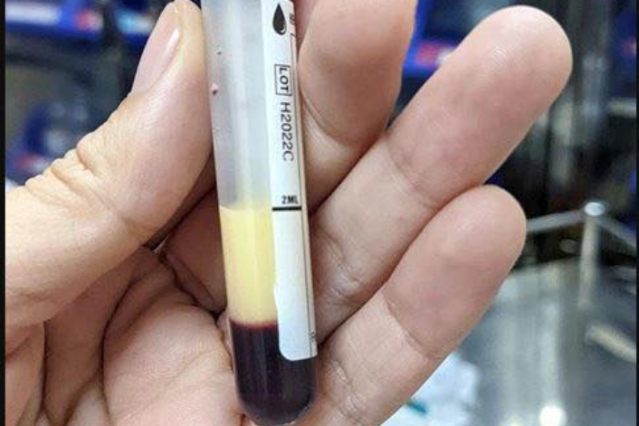 Tiệc tùng suốt tháng Tết, người đàn ông trẻ nhận xét nghiệm máu đục trắng như sữa