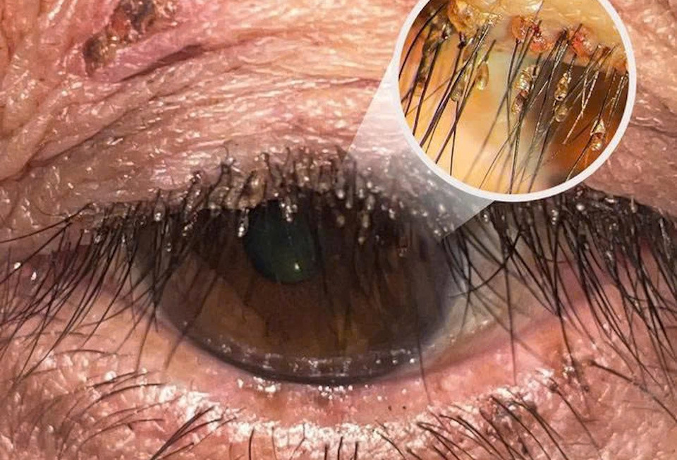  Bác sĩ bất ngờ về ổ rận mu bám chi chít trên lông mi người phụ nữ 