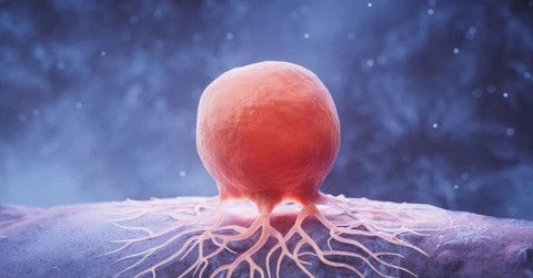 Loại ung thư đứng đầu số ca mắc ở Việt Nam, di căn nhanh