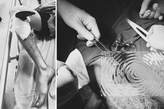 Bản tin cuối ngày 18/3: Lưỡi máy mài văng ra găm vào gối người đàn ông 43 tuổi