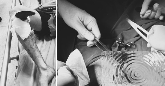 Bản tin cuối ngày 18/3: Lưỡi máy mài văng ra găm vào gối người đàn ông 43 tuổi