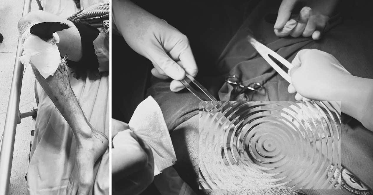 Lưỡi máy mài văng ra găm sâu vào gối người đàn ông 43 tuổi