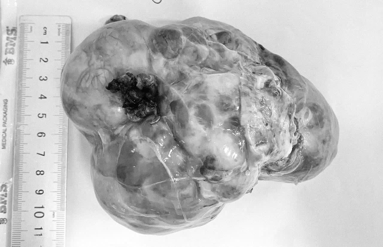 Nhiều trẻ mắc u ổ bụng không triệu chứng, bác sĩ cảnh báo dấu hiệu dễ bỏ qua z7631455959101_34256d30be73127693ddb6661454c066.jpg