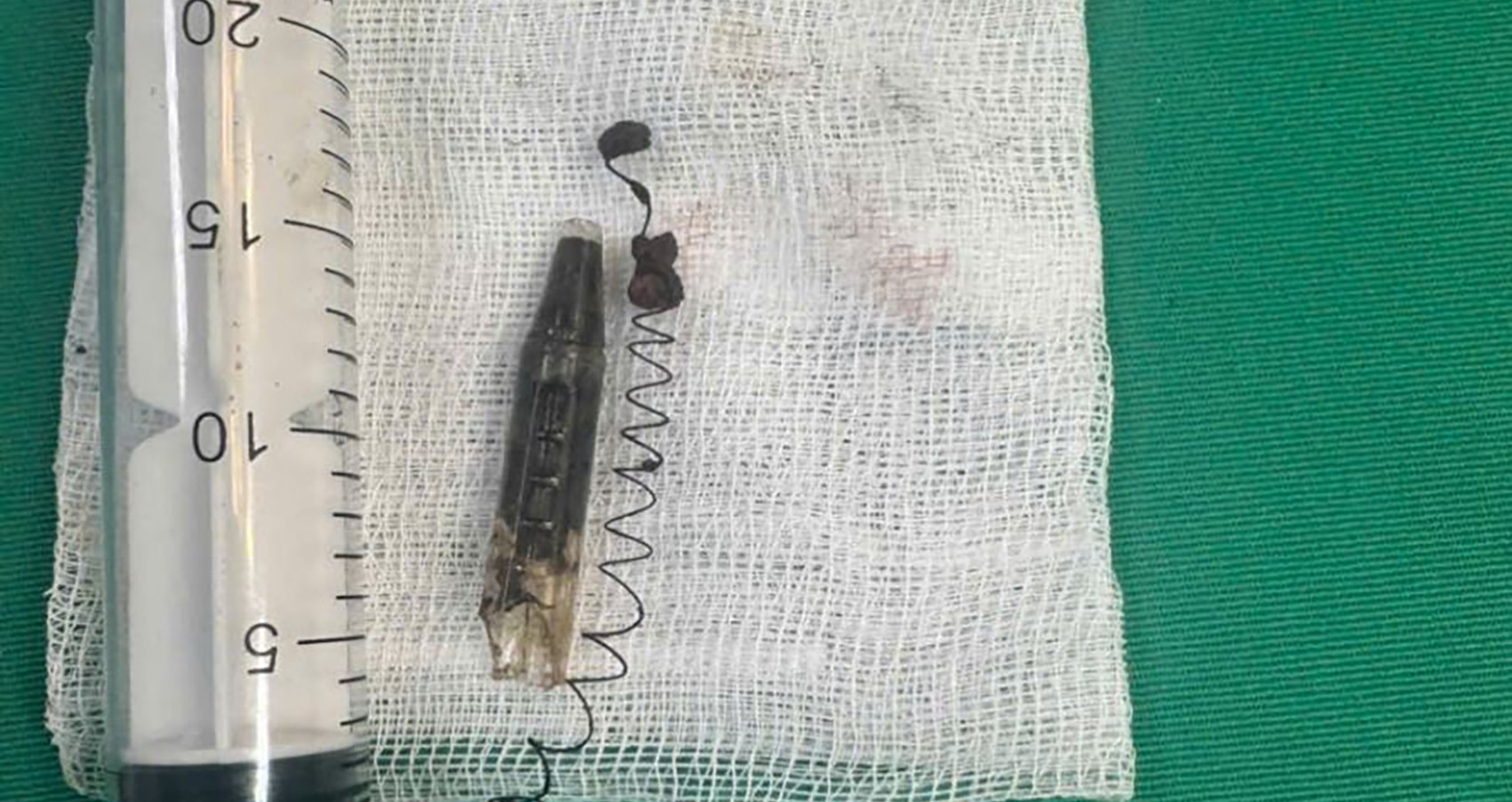 Thanh niên 29 tuổi bị đầu bút, lò xo găm trong thái dương suốt 13 năm