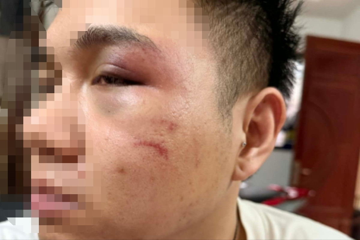 Hà Nội: Từ chối chở khách say xỉn, tài xế xe công nghệ bị đánh sưng mặt