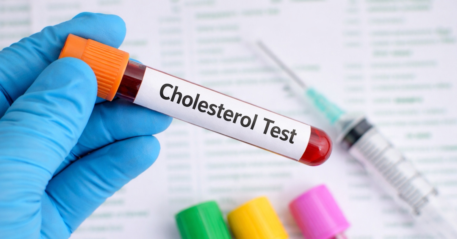 3 dấu hiệu ở mắt có thể cảnh báo mỡ máu cao từ sớm