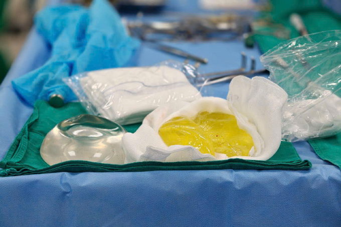 Cô gái trẻ tá hỏa vì túi ngực bỗng nhiên vỡ nát