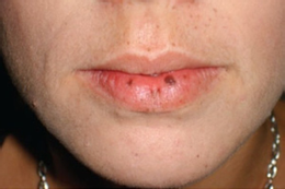 Tưởng mệt mỏi do áp lực, nhiều người trẻ bàng hoàng phát hiện ung thư đại tràng YwAAAAAAQABAAACAUwAOw==