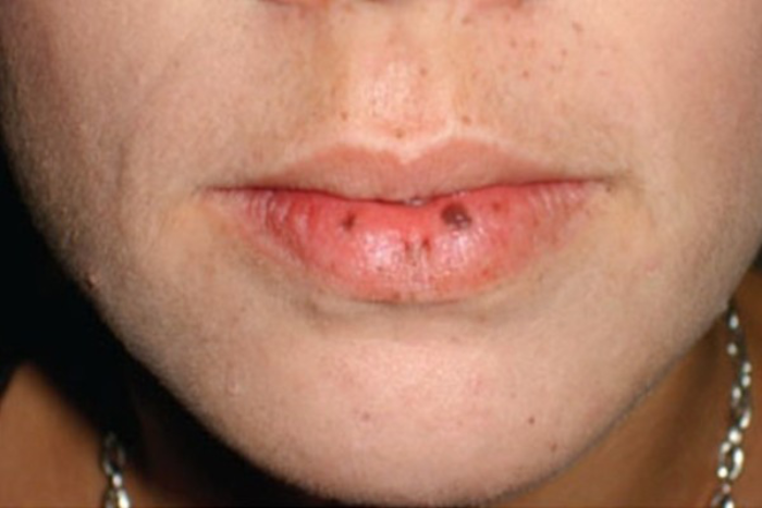 Nốt đen trên môi hé lộ bệnh di truyền gây ung thư trong một gia đình