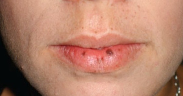 Nốt đen trên môi hé lộ bệnh di truyền gây ung thư trong một gia đình