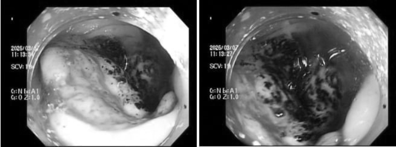 0ung thu dai trang.png