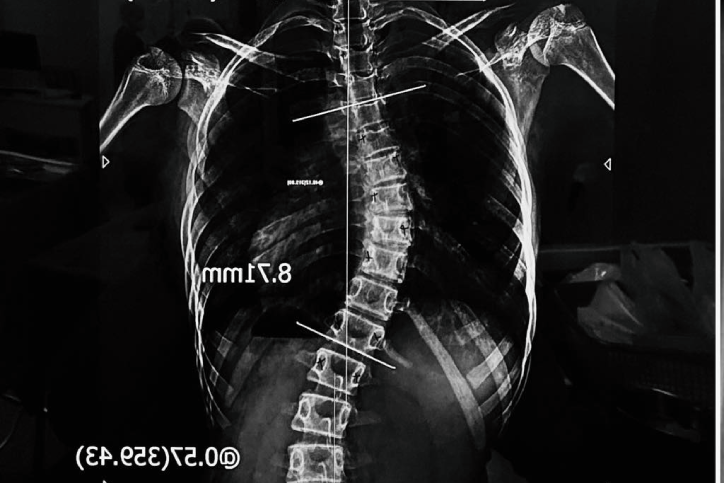 Chi tiền lớn 'nắn thẳng lưng' cho con