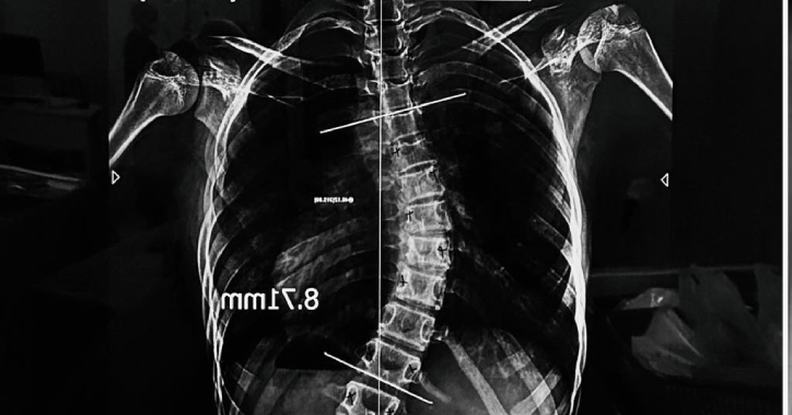 Chi tiền lớn "nắn thẳng lưng" cho con
