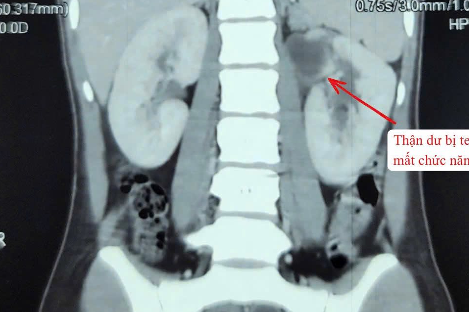  Hiếm gặp cô gái có 3 quả thận 