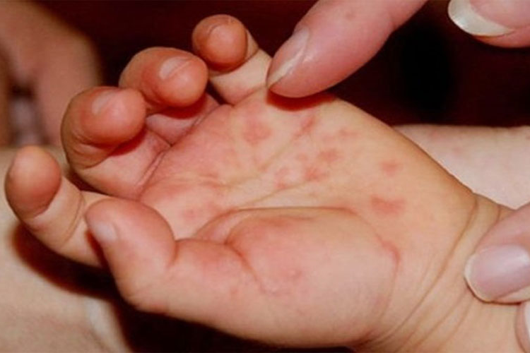 Số ca tay chân miệng tăng gấp 5 lần, 4 trẻ tử vong, Bộ Y tế chỉ đạo khẩn