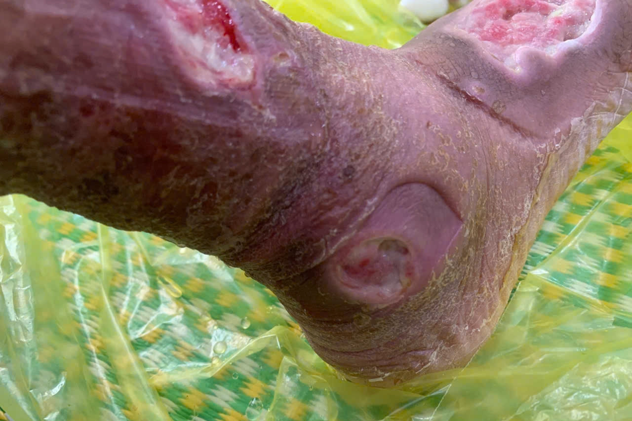 Dẫm phải gai hoa hồng, người phụ nữ ở Vĩnh Phúc đối diện nguy cơ cắt cụt chi