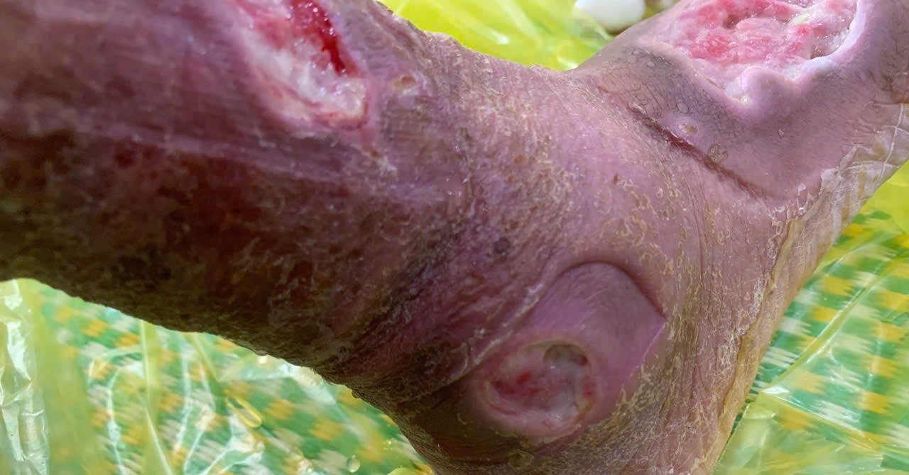 Dẫm phải gai hoa hồng, người phụ nữ ở Vĩnh Phúc đối diện nguy cơ cắt cụt chi