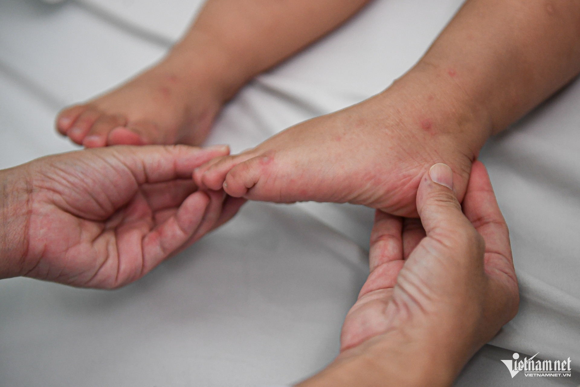 48 giờ mắc tay chân miệng, trẻ ngưng thở, lọc máu khẩn ở bệnh viện tuyến cuối W-tây chân miệng nguyễn huế 13.jpg