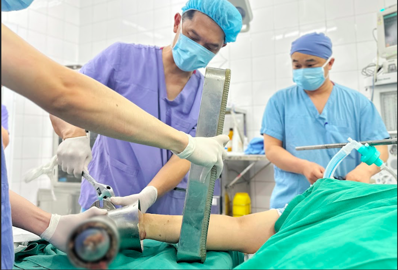 Bàn tay mắc kẹt trong máy xay thịt, người phụ nữ trẻ phải cắt cụt chi