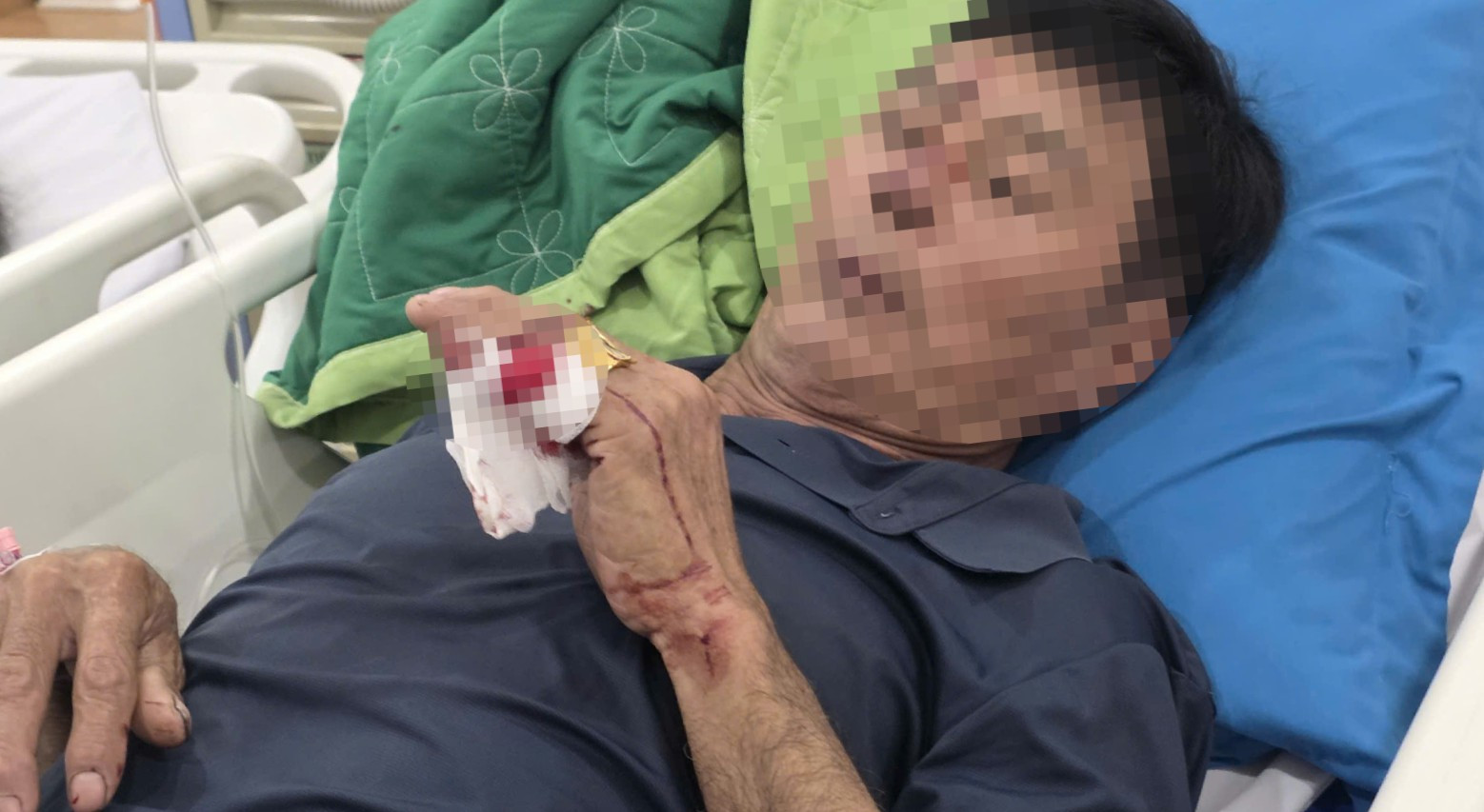 Một nạn nhân phải phẫu thuật cau ghenh (1).jpg