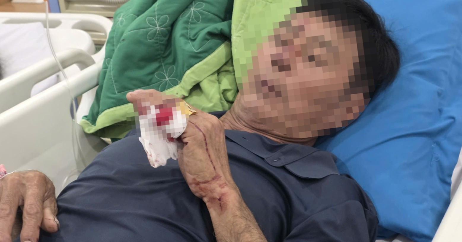 Vụ sà lan tông cầu Ghềnh: Một nạn nhân phải phẫu thuật