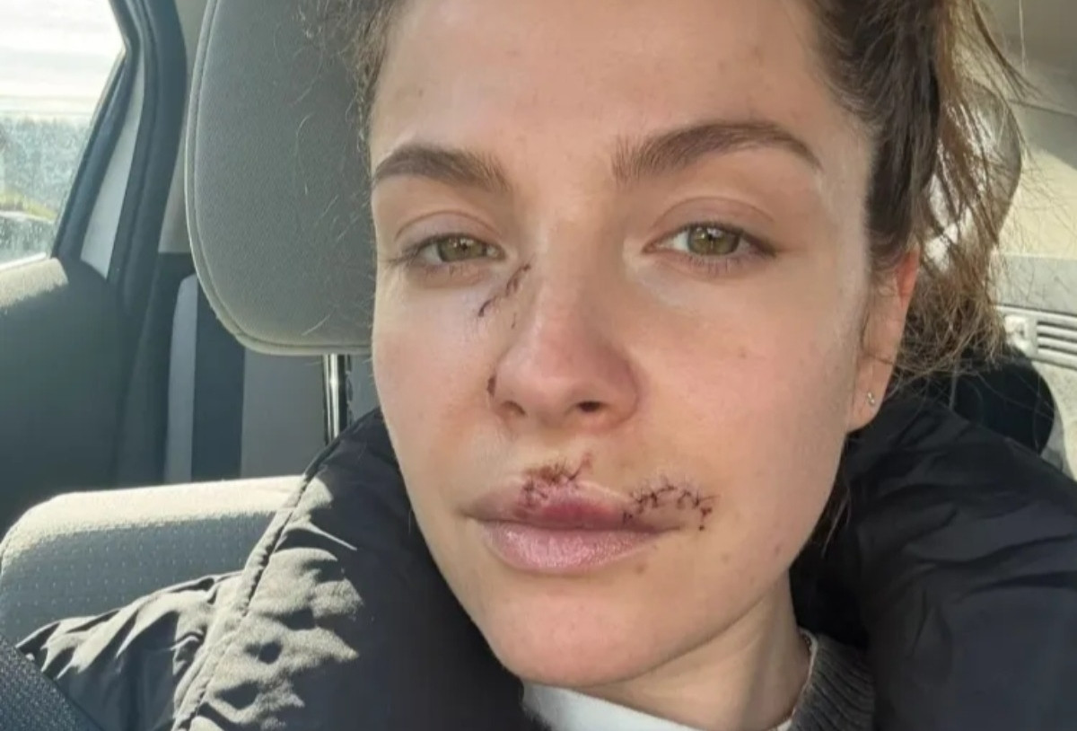  Nữ diễn viên 37 tuổi lộ gương mặt đầy vết thương sau vụ bị chó cắn 