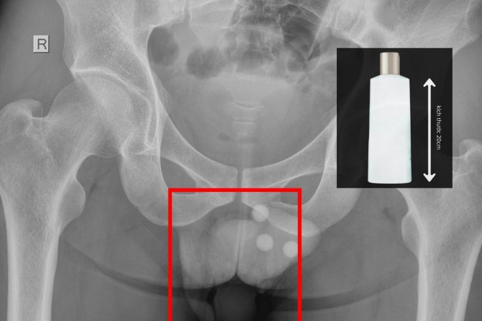 Người đàn ông cấp cứu với chiếc chai nhựa dài trong trực tràng cấp cứu 10.png