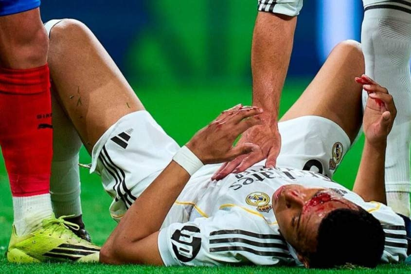  Mbappe đổ máu trên sân, Real Madrid tức giận bị ‘cướp’ phạt đền 