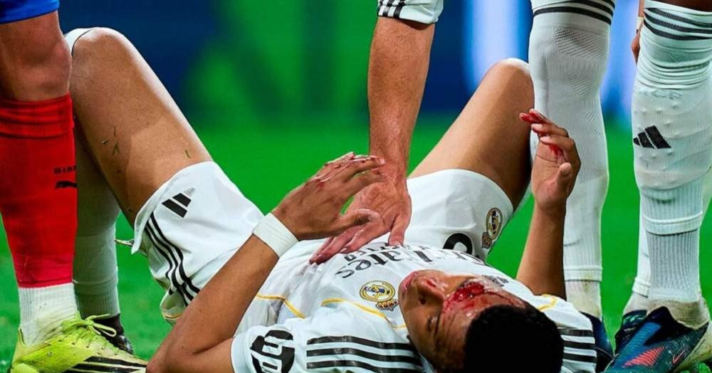Mbappe đổ máu trên sân, Real Madrid tức giận bị ‘cướp’ phạt đền
