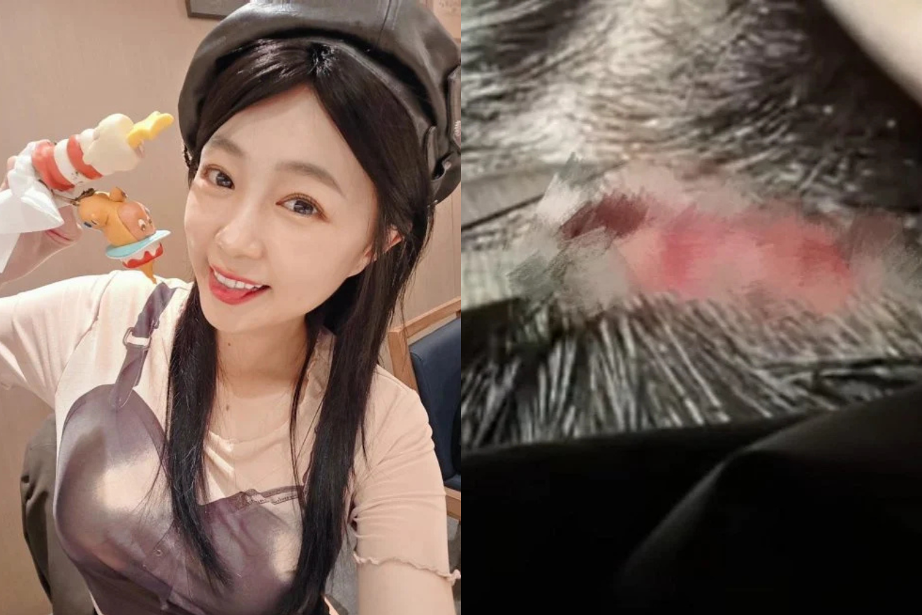 Nữ diễn viên 38 tuổi ngã đập đầu, khâu 5 mũi ngay sinh nhật