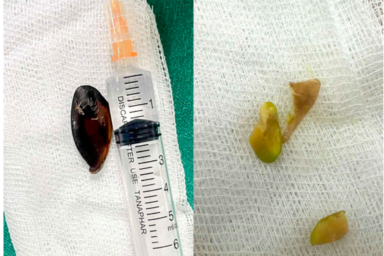 Dị vật mắc kẹt trong đường thở của trẻ suốt 13 tháng