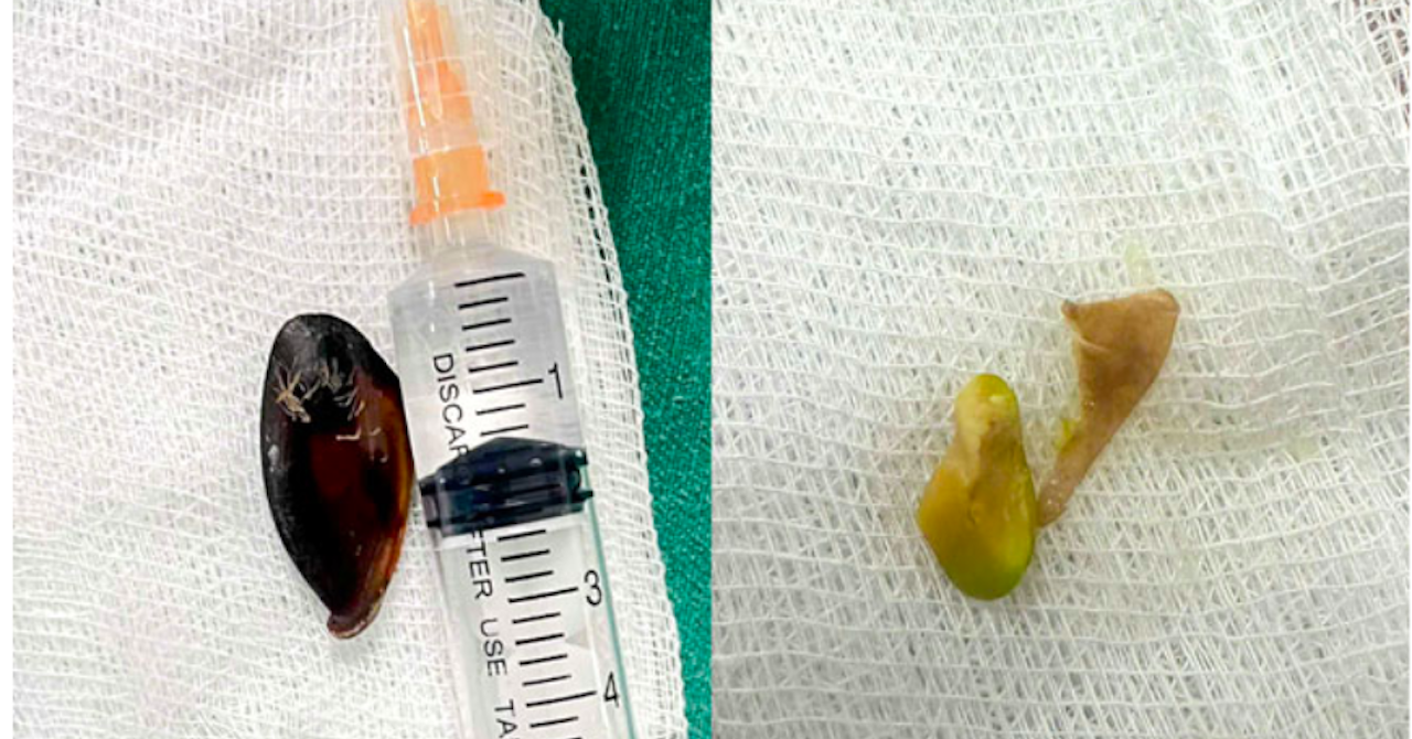 Dị vật mắc kẹt trong đường thở của trẻ suốt 13 tháng