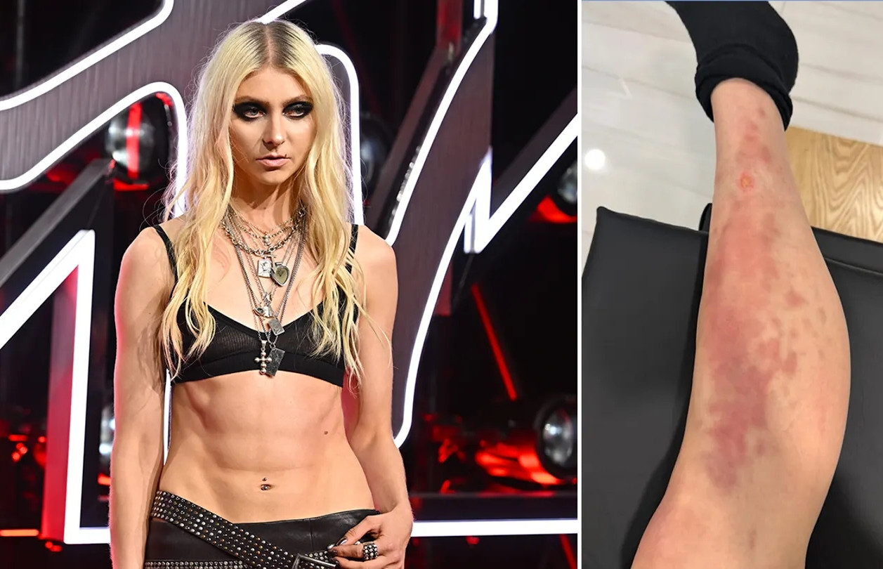 Nữ ca sĩ 33 tuổi nhập viện cấp cứu vì bị nhện độc cắn