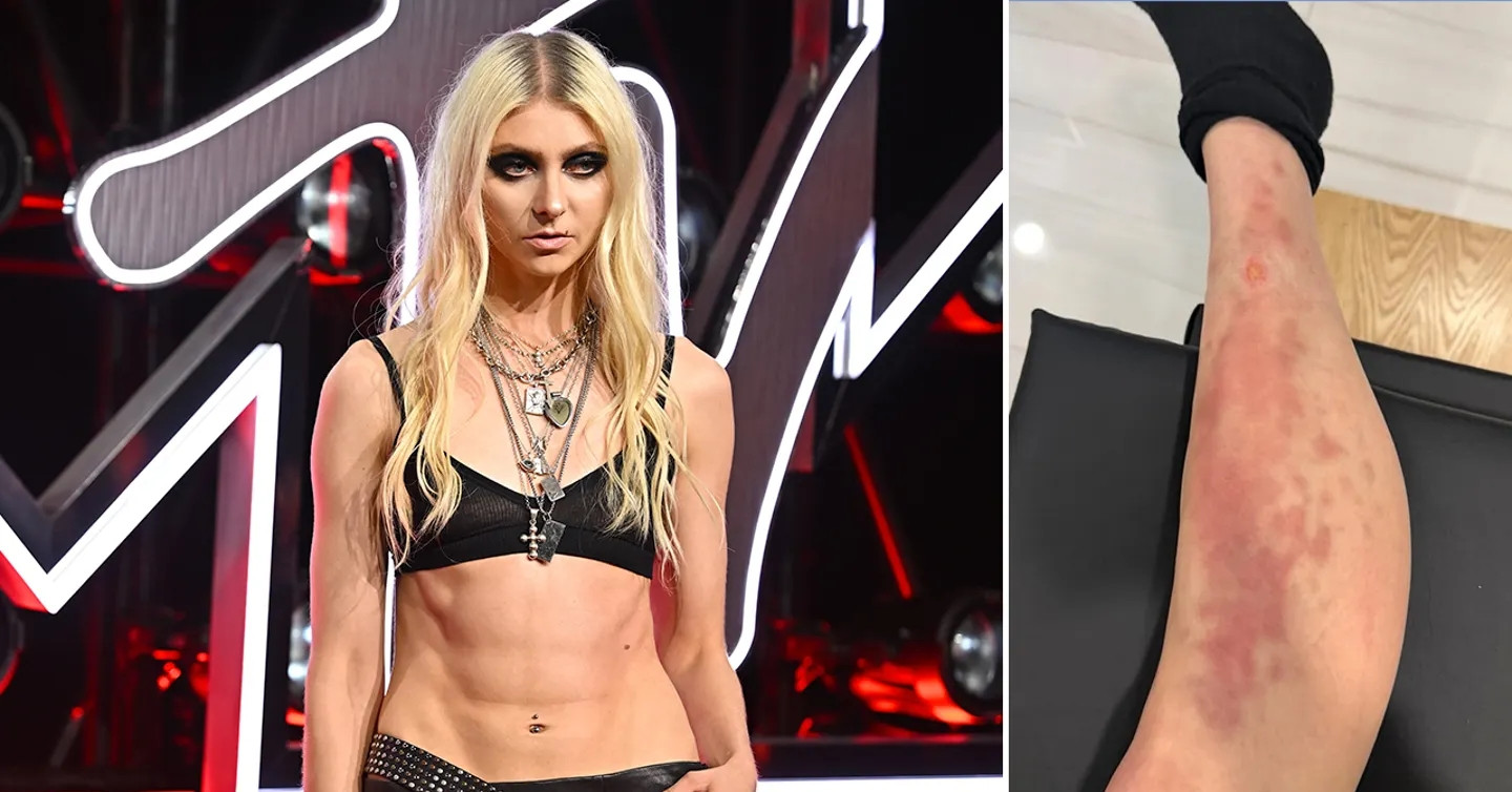 Ca sĩ Taylor Momsen nhập viện cấp cứu sau khi bị nhện độc cắn tại buổi diễn