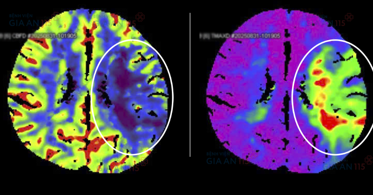 "Khe cửa hẹp" giúp người đàn ông thoát nguy kịch vì đột quỵ sau 34 giờ