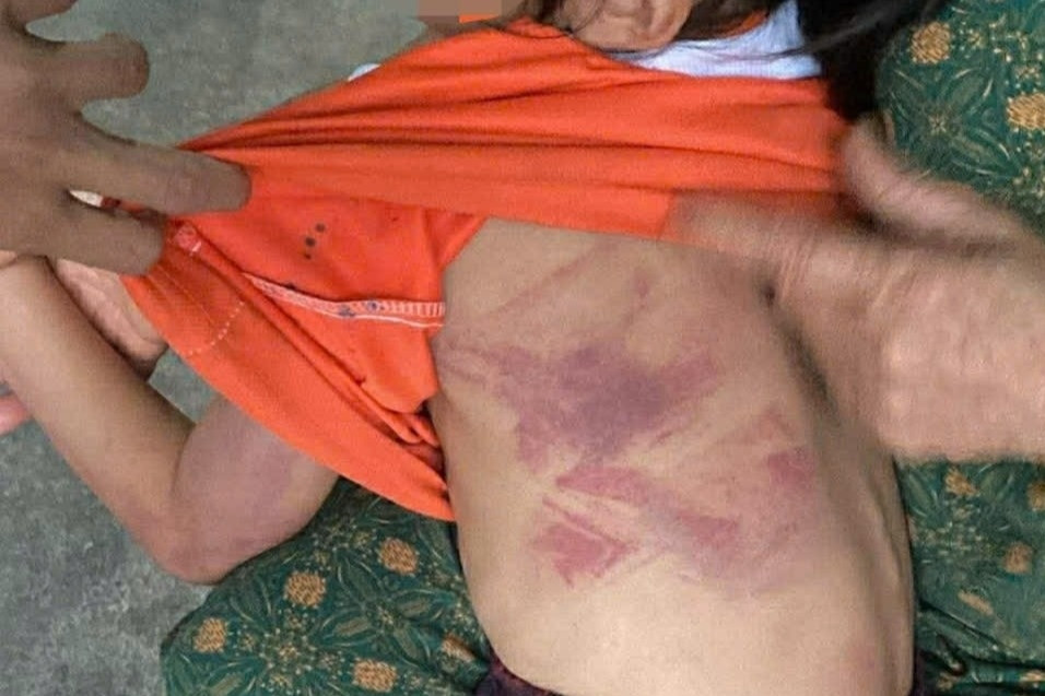 Bé gái lớp 2 bị bạn dùng thước đánh bầm tím người