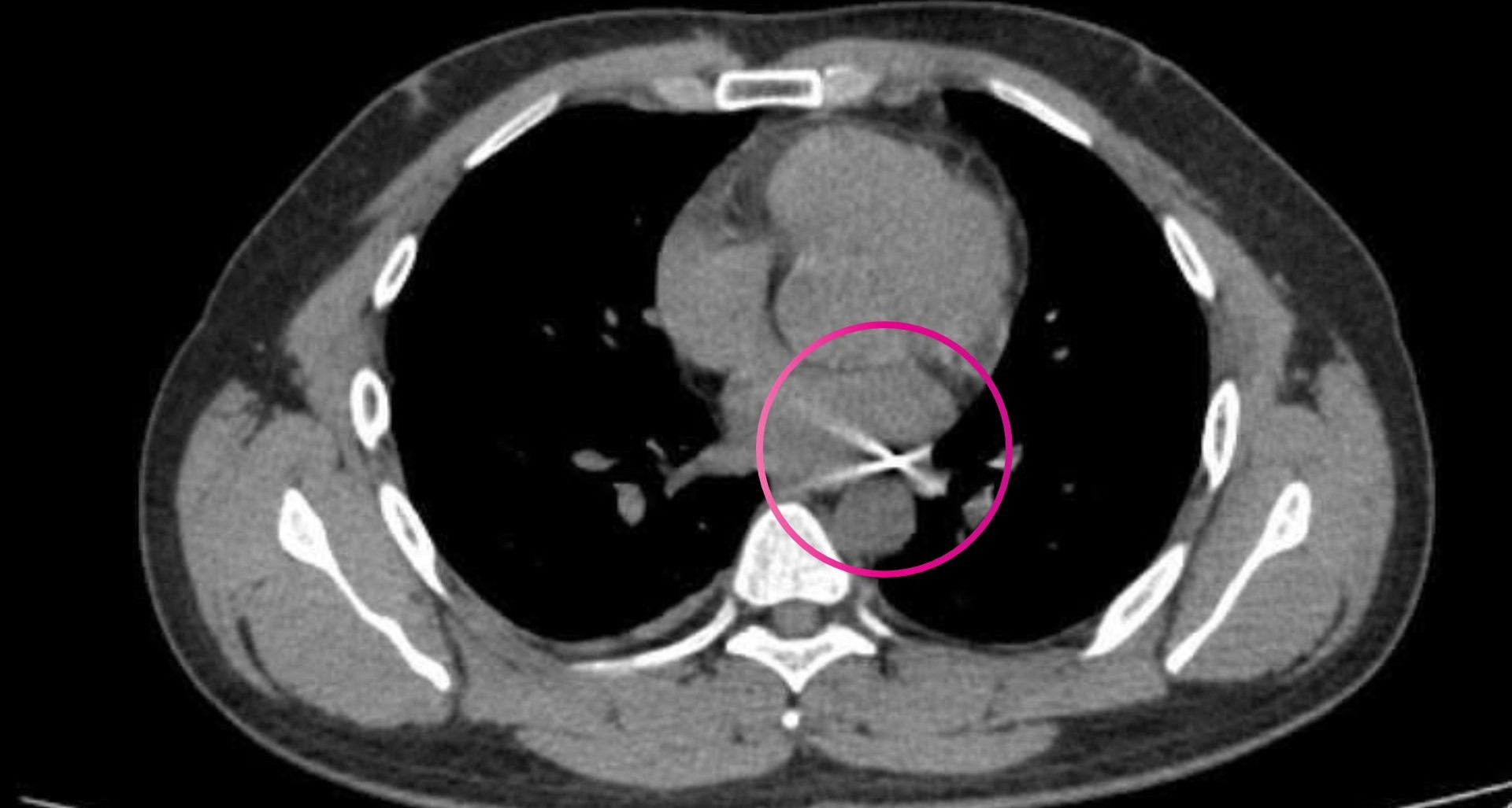 Các bác sĩ 3 chuyên khoa suốt 4 giờ lấy viên đạn kẹt ở ngực người đàn ông trẻ