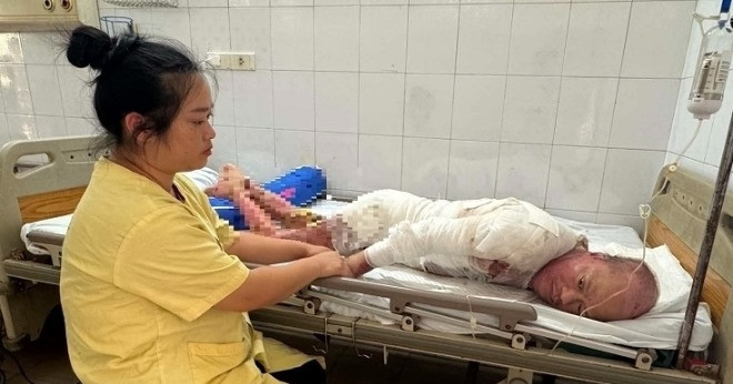 Chồng tâm thần bị bỏng nặng, vợ nghèo bán sạch tài sản không lo đủ viện phí