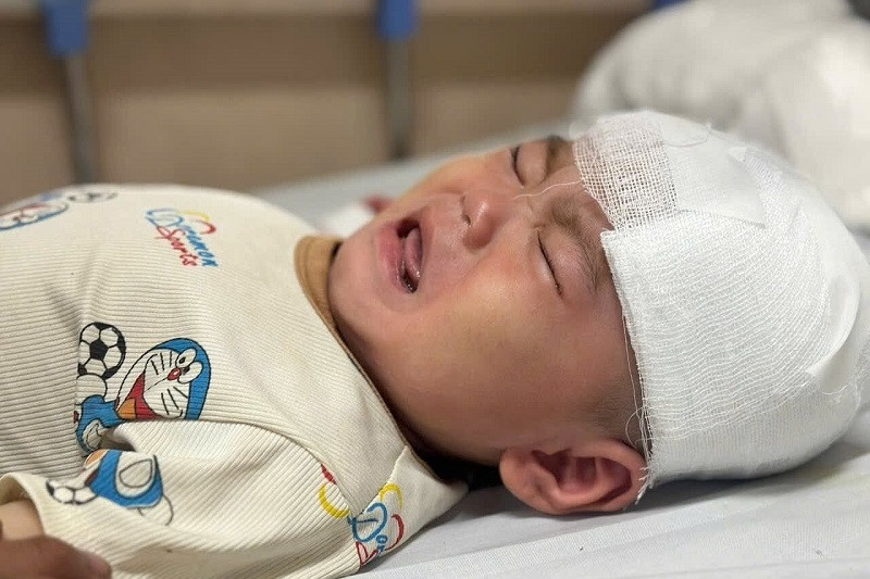 Bé trai 1 tuổi ngã nguy kịch, gia đình bán cả con trâu không đủ tiền điều trị