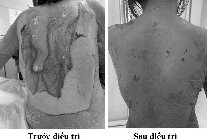 Người phụ nữ Hải Phòng bị tróc da như 'cua lột', lý do tự mua thuốc dị ứng