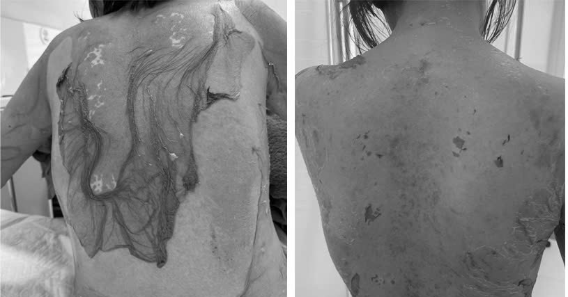 Người phụ nữ Hải Phòng bị tróc da như "cua lột", lý do tự mua thuốc dị ứng