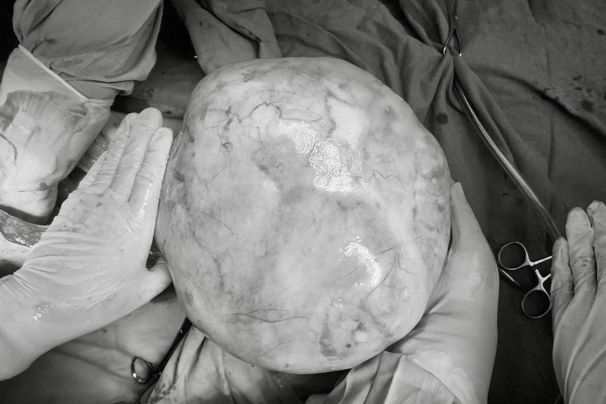 Bé gái 14 tuổi mang khối u khủng, dấu hiệu dễ nhầm với tăng cân tuổi dậy thì